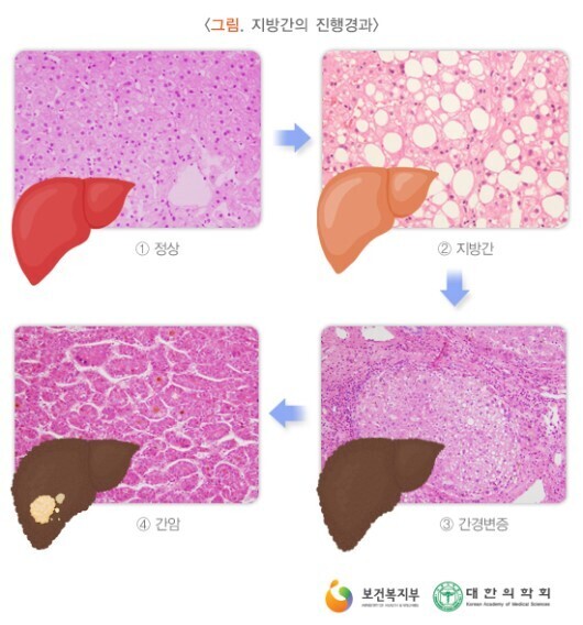 간경변증,간암시-간모습