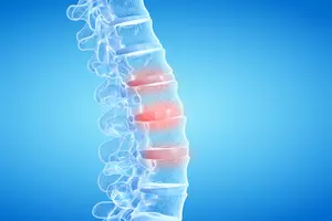 허리디스크-원인