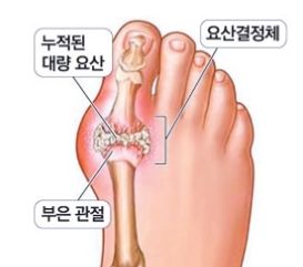 발가락 통풍 증상