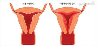 생리통 심할때