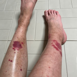 자반증 - 종아리 다리