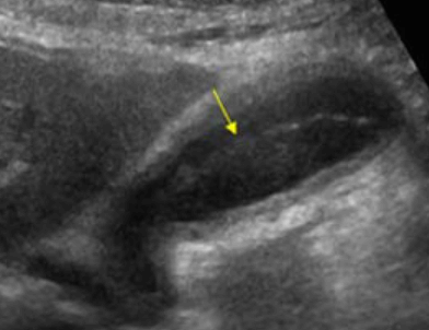 괴저성 담낭염 (Gangrenous cholecystitis)