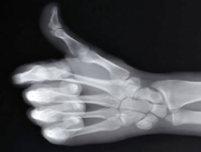 고사리-뼈건강-강화