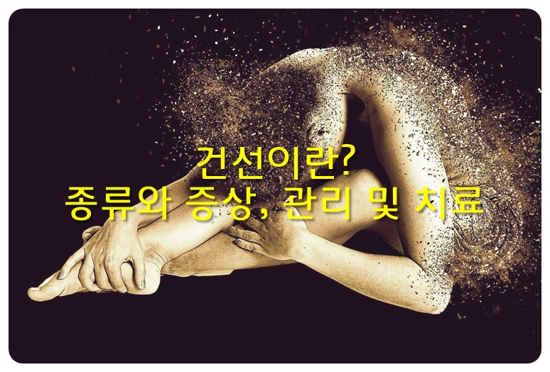 건선이란, 종류와 증상, 관리 및 치료