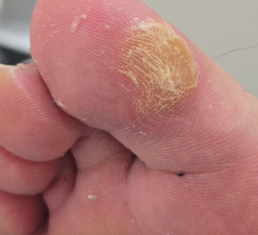 굳은살 티눈 차이 (피부구조, 원인, 제거법)