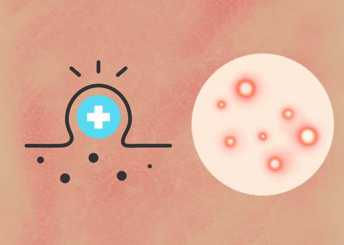 피부에-발생한-종기