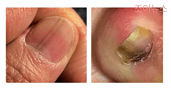 조갑종양(흑색종)