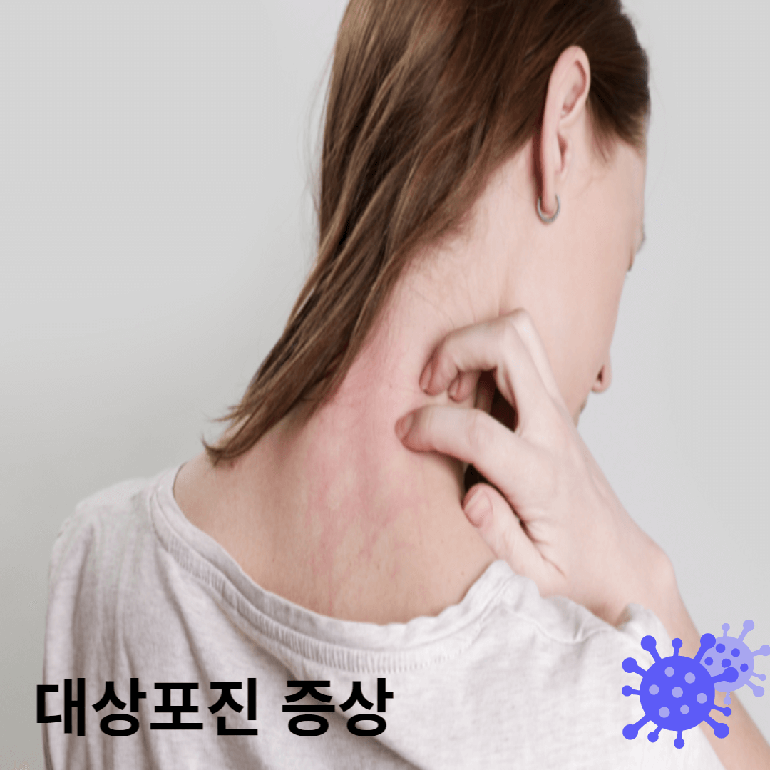 대상포진 발병 사진
