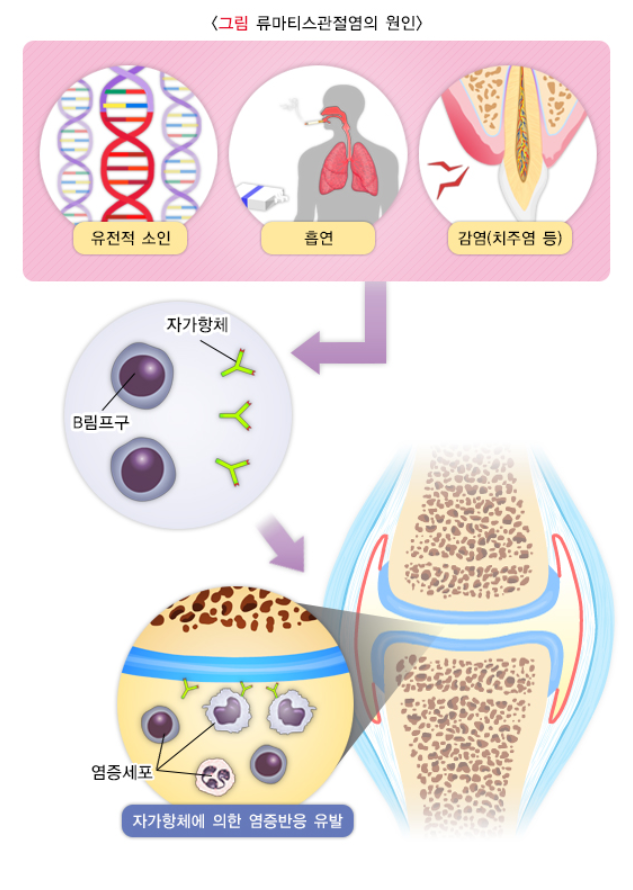 류마티스 관절염(RA&#44; rheumatoid arthritis)