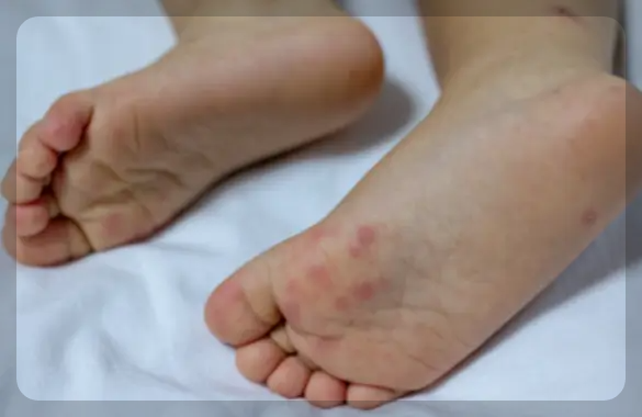 발에 난 수족구