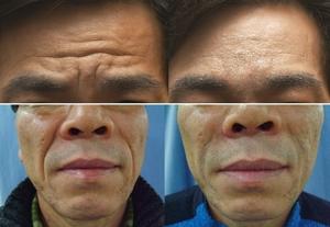 미간 주름 필러