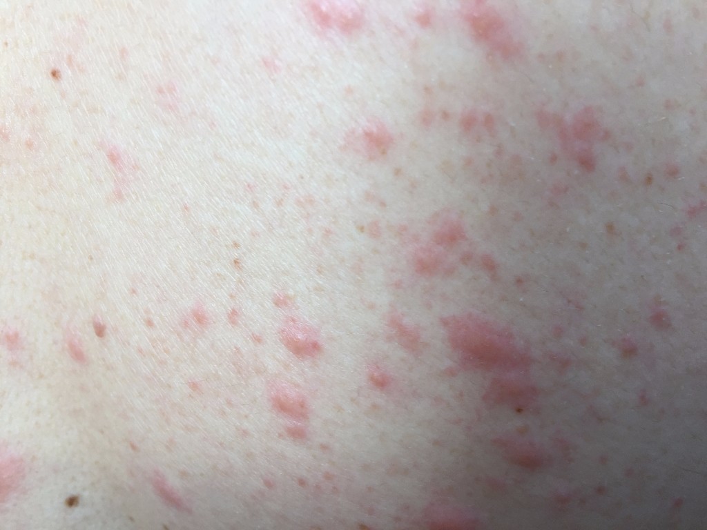 빈대 물린자국 2