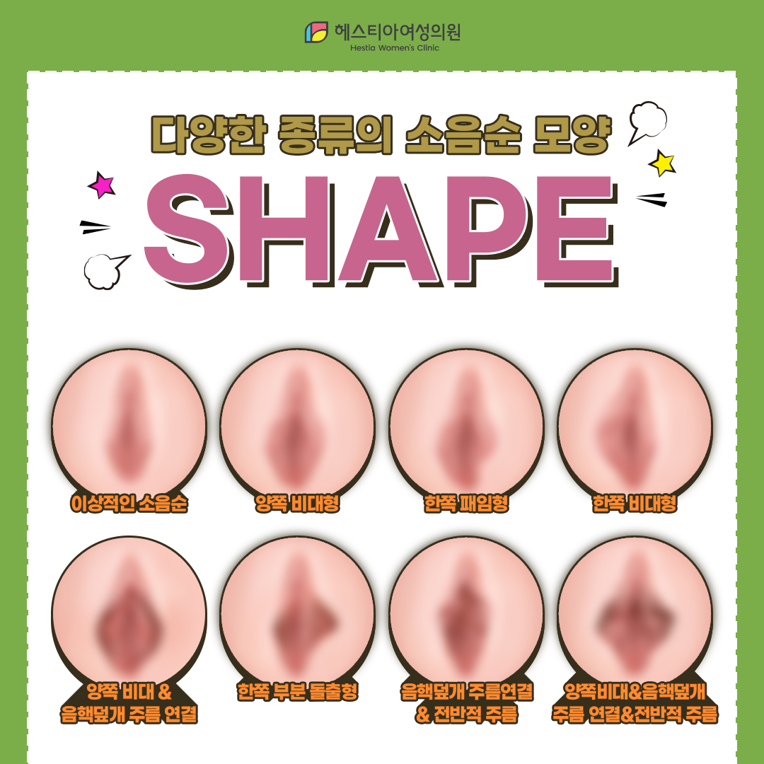 다양한 종류의 소음순 모양