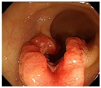 대장암 초기증상 혈변 원인