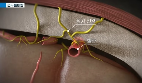 편두통이란