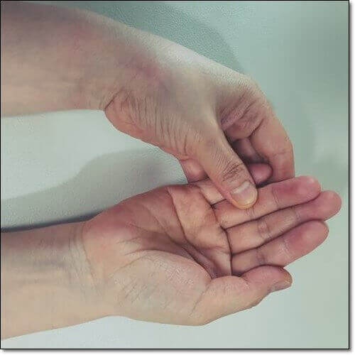 척골충돌증후군 치료, 새끼손가락 만지는 척골충돌증후군 환자