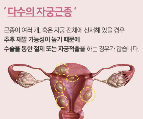 자궁근종 증상 수술 회복기간 알아보기(25년 ver)