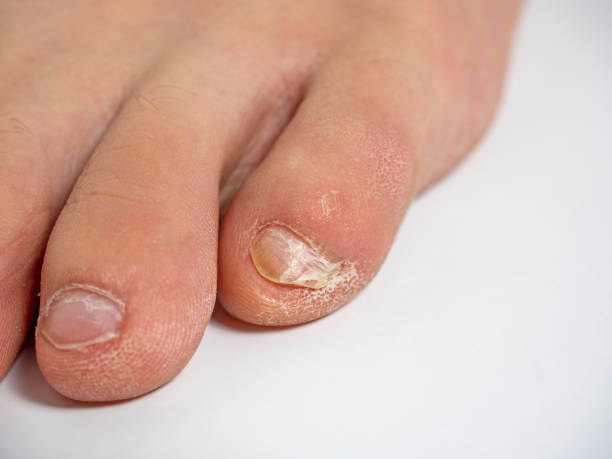 새끼발톱 갈라짐, 원인과 예방방법 때로는 작은 부위에 대한 관심 부족으로 인해 큰 문제가 발생할 수 있습니다. 이번 글에서는 새끼발톱이 갈라지는 이유와 예방 방법, 그리고 집에서 할 수 있는 치료 방법을 참고하시기 바랍니다. 이제부터 새끼발톱에 대한 지식을 쌓아 보세요.