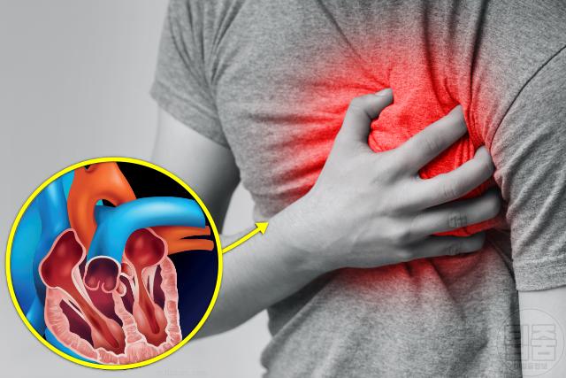 심근경색 전조증상 송대관 사망 원인 가슴 압박 통증