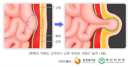 탈장 치료 선택 전 꼭 알아야 할 과학적 기준
