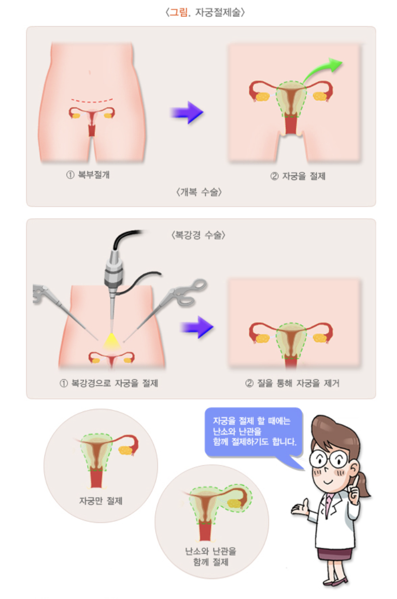 자궁절제술