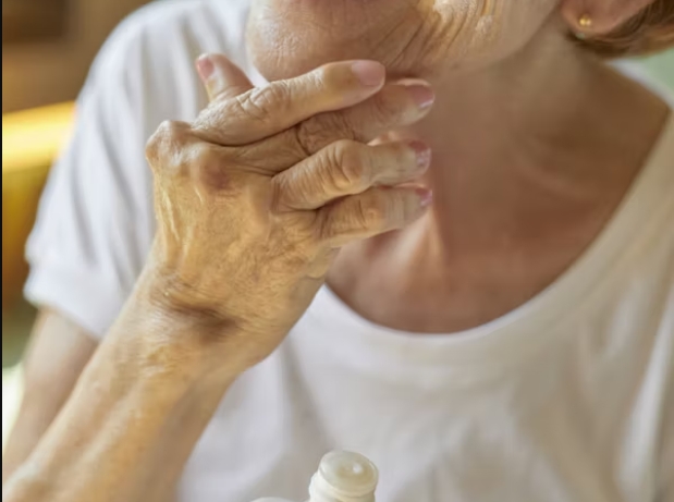 류마티스관절염 변형손가락사진