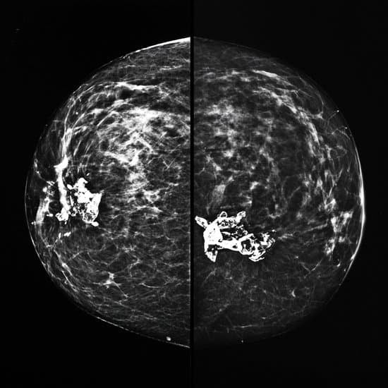 유방촬영술 결과 해석: 의심 (Suspicious, BI-RADS 4) 조직검사 권유