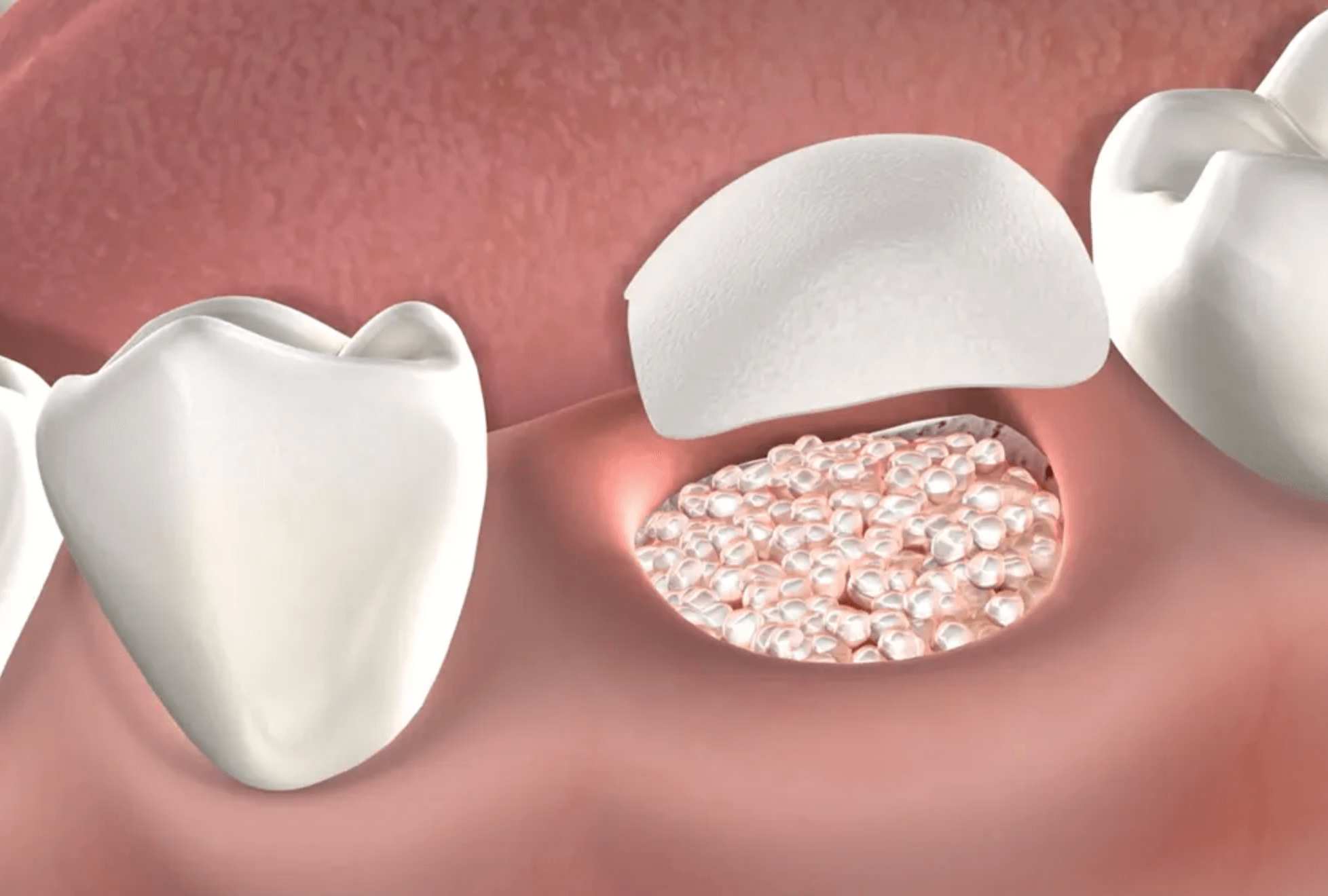 임플란트 뼈이식