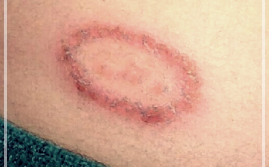 체부백선: 이해, 치료법, 그리고 관리