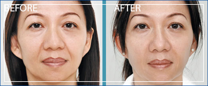 엘란쎄 필러 비포 애프터