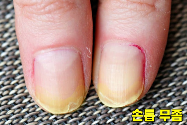 손톱 노란색 손톱 무좀, 건선 기관지염, 손톱으로 보는 건강상태, 건강 팁줌 매일꿀정보