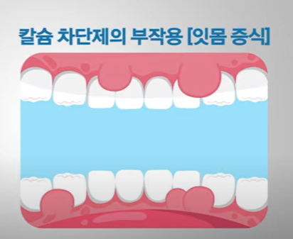 칼슘채널차단제 부작용