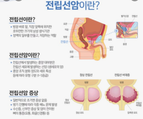 전립선암