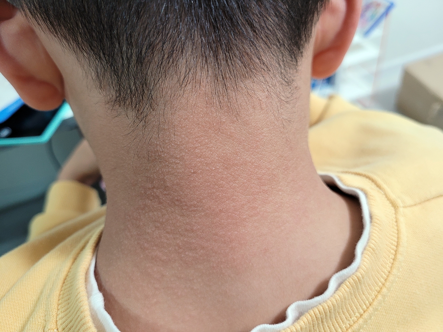 햇빛 알레르기 증상