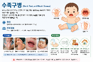 수족구병 증상, 격리기간까지 총정리! 어린이집 등원은 언제 가능할까요?