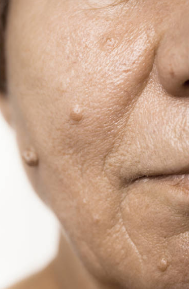 쥐젖 제거방법, 쥐젖이 생기는 이유, 제거 연고 총정리 (2024ver)