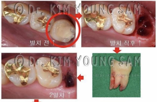 사랑니 발치 후 식사 가이드