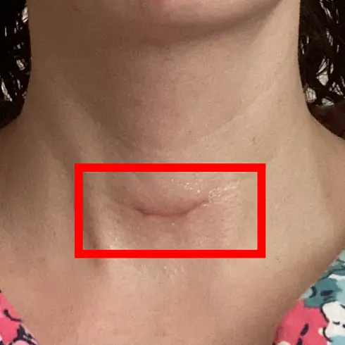 갑상선암 수술 흉터 사진