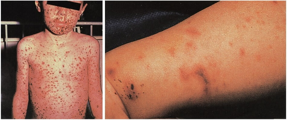 수막구균 혈류 감염으로 인한 광범위한 발진