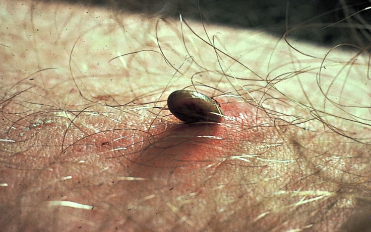 진드기물린자국,집먼지진드기물린자국,진드기물린자국증상,이불진드기물린자국,진드기퇴치제,진드기 알레르기