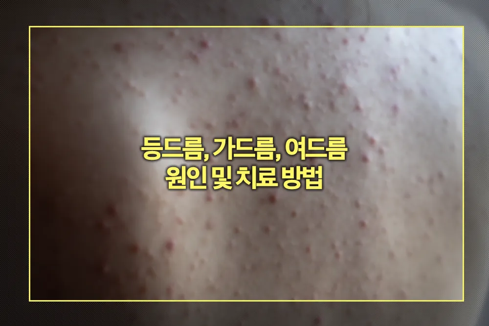 등드름, 가드름, 여드름 원인 및 치료 방법