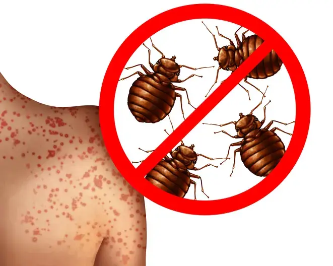 빈대물렸을때증상3