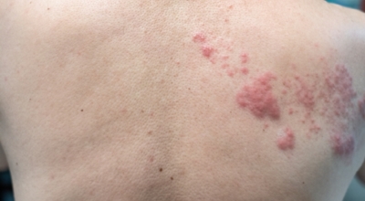 대상포진이미지