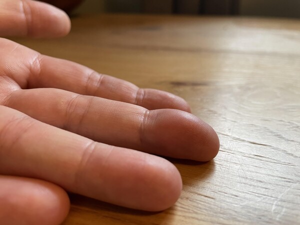 손가락이 &lsquo;이 모양&rsquo; 이라면&hellip; 당장 병원부터 가세요.
