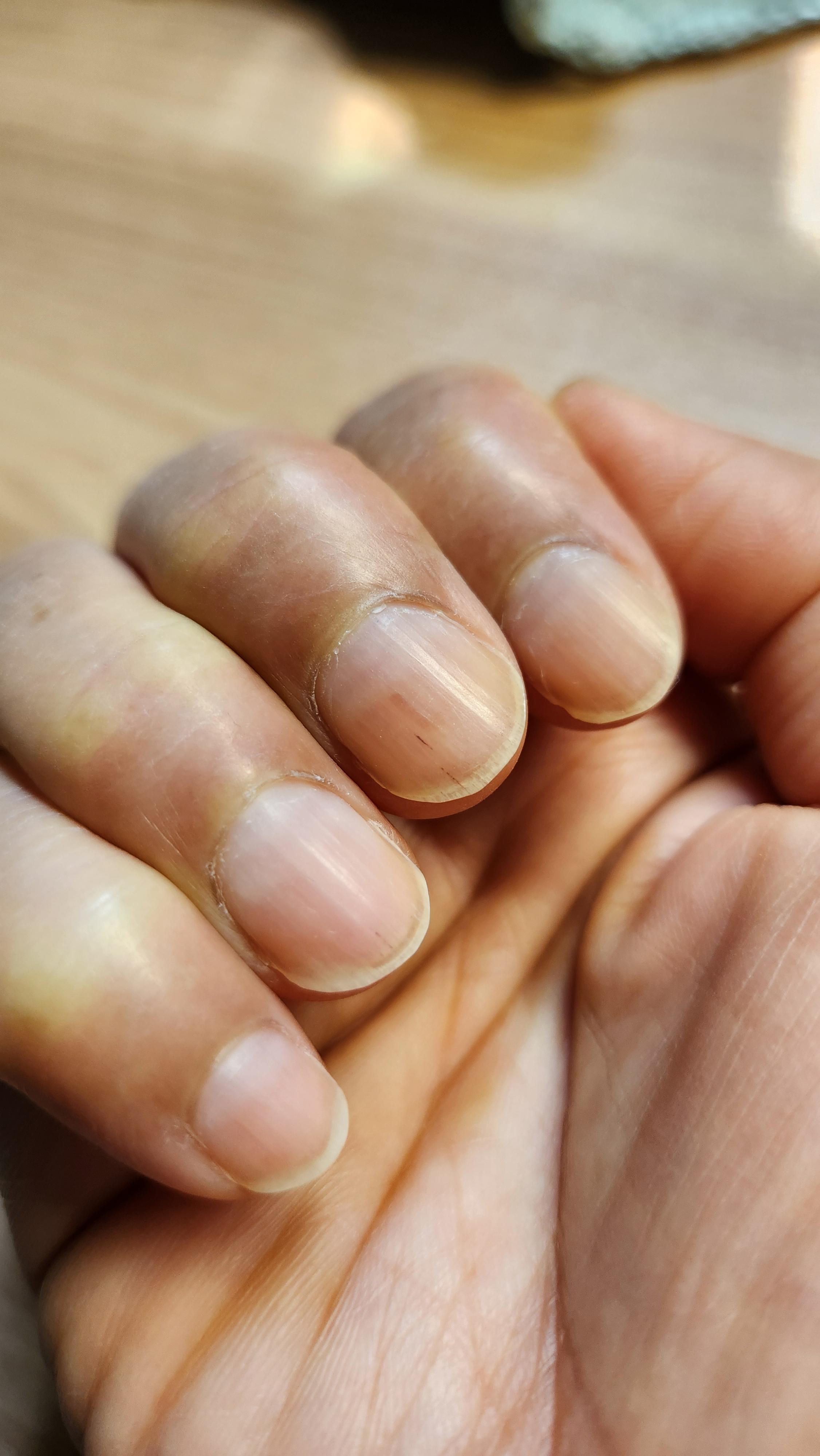 유방암 항암 부작용