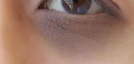 갑상선 기능 저하증