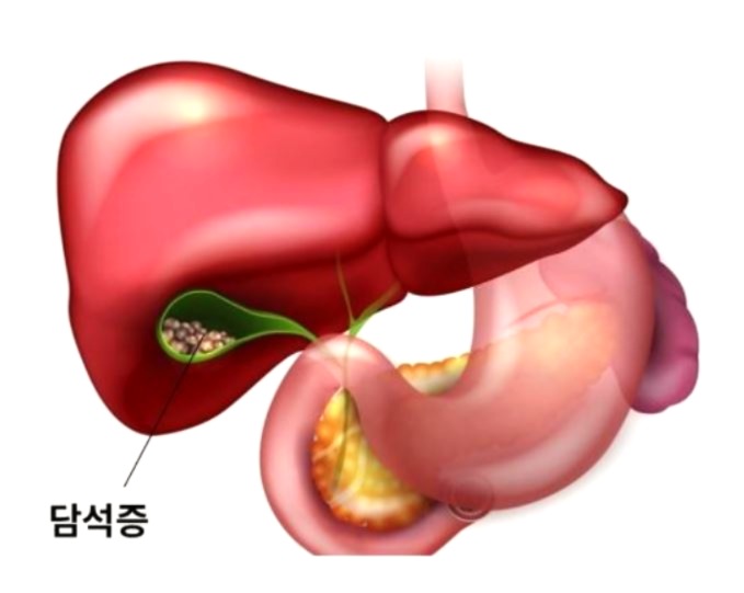 담석증 이미지