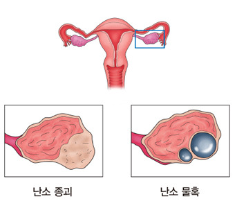 난소암 초기증상