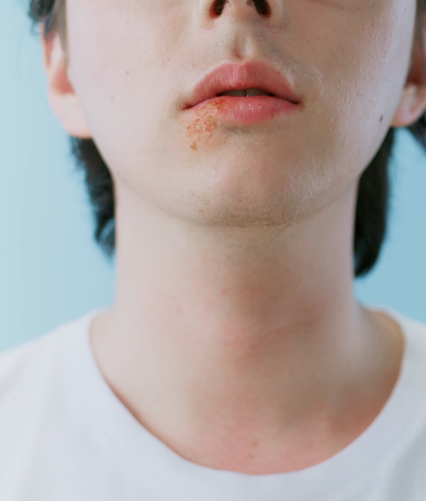 대상포진에 좋은 음식