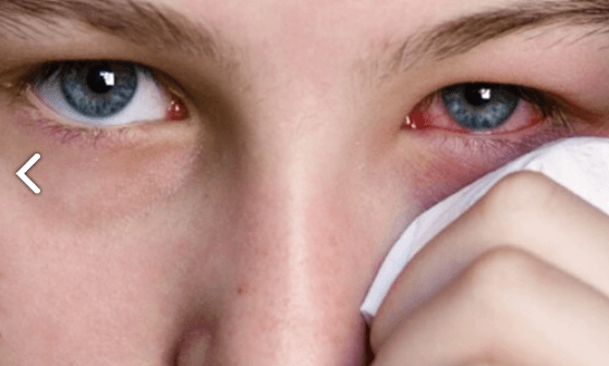 눈 실핏줄 터짐 관련 사진